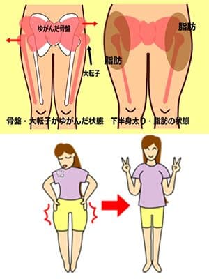 下半身肥胖都係因為盆骨移位！快來檢查盆骨！