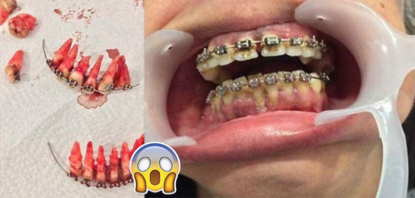 箍牙變甩牙？箍牙前要清楚的3件事，小心自己箍錯牙！（有圖慎入）