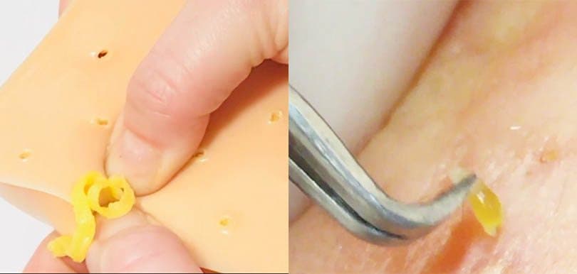 【唔使紅腫！】教你3個清粉刺正確方法，呢種「擠粉刺神器」想唔想要？