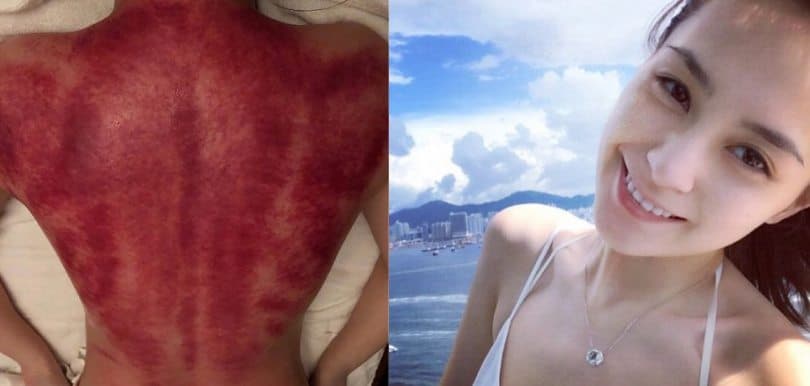 阿嬌刮痧背脊勁紅嚇親人！刮痧、拔罐究竟有咩功效？