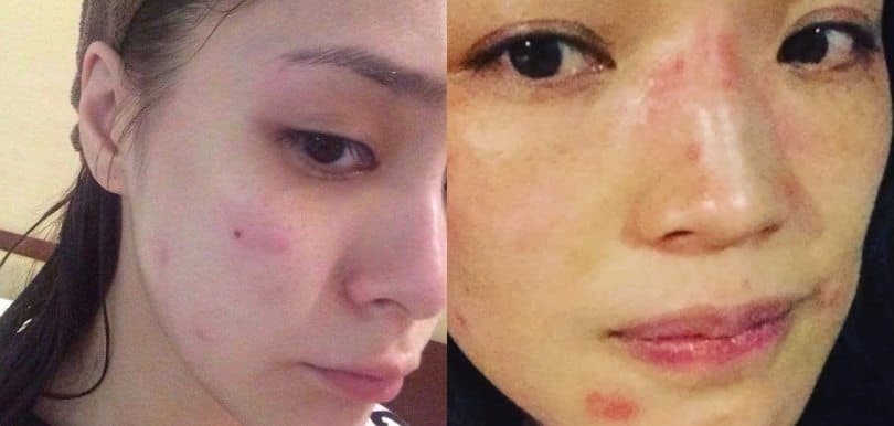 【醫生專欄】亞洲人的皮膚特別差？