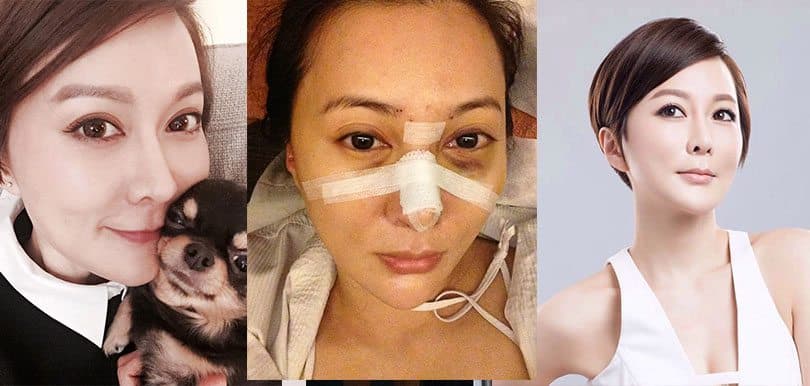 陳莉敏自嘲「毀容達人」， 盤點整容成敗清單！