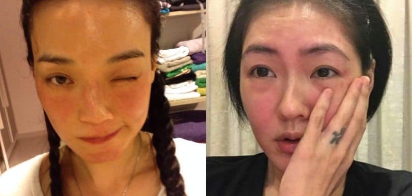 【醫生專欄】容易面紅要小心，可能係玫瑰痤瘡！