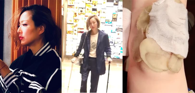 鄭秀文排練演唱會傷膝！教網民偏方薯仔敷傷口消炎去腫