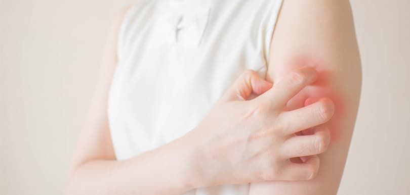 一轉天氣皮膚就開始痕？醫生指手多多容易令濕疹惡化