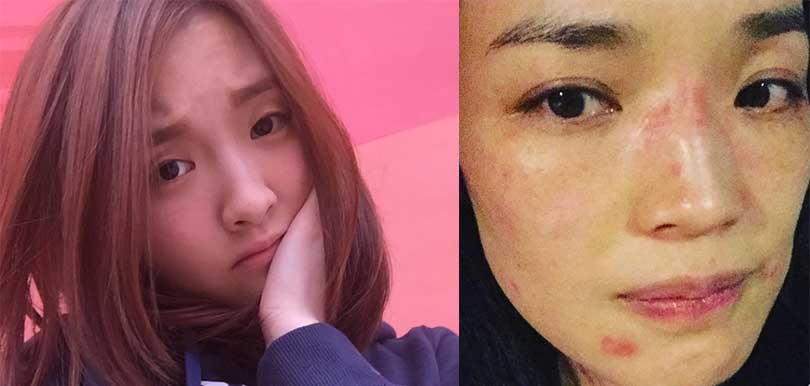 【醫生專欄】有石頭瘡/囊性痤瘡怎麼辦？夏天必看暗瘡急救法
