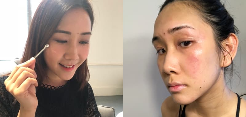 編輯過敏皮膚真實分享！慢性蕁麻疹及戒類固醇適用美容產品