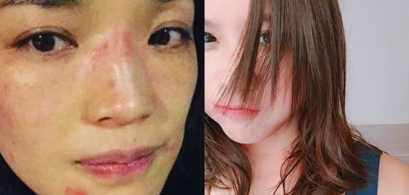 醫生教你提防誤購類固醇藥膏！用法不當可致「類固醇上癮」
