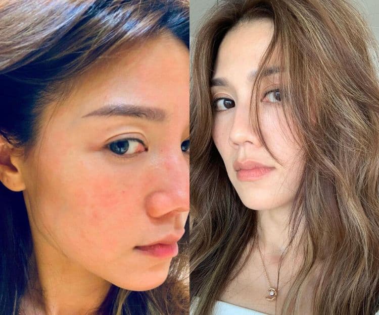 皮膚敏感丨周秀娜是過敏常客？親授3招必學皮膚快速急救法：濕敷療法最見效！