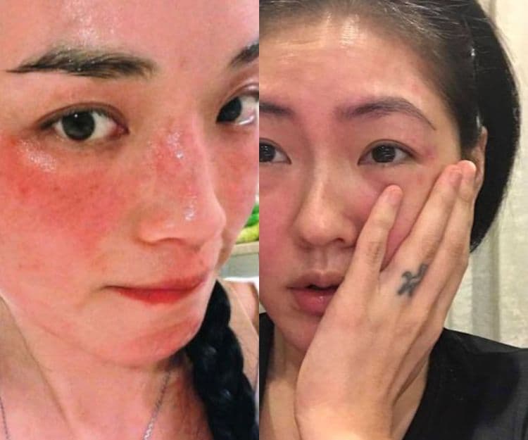 濕疹、敏感肌有救！美國濕疹協會推薦7大保濕面霜 香港都買到！