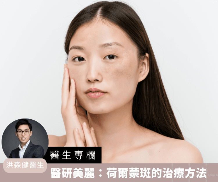 【醫生專欄】醫研美麗：荷爾蒙斑的治療方法