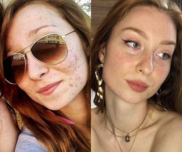 英國化妝師花10萬食A酸做療程治暗瘡零成效！靠7個低成本抗痘法拯救爛臉：要喝XX排毒、最緊要保濕！