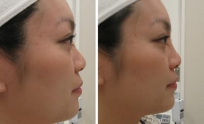 客席編輯推介─提升鼻樑 Juvederm 填充劑注射