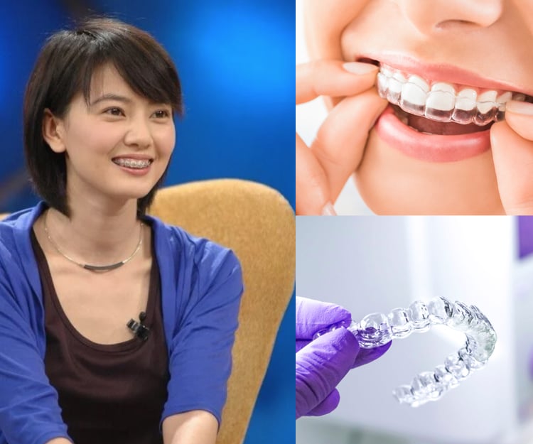 傳統vs隱形牙箍邊樣好？傳統現代箍牙技術大比拼